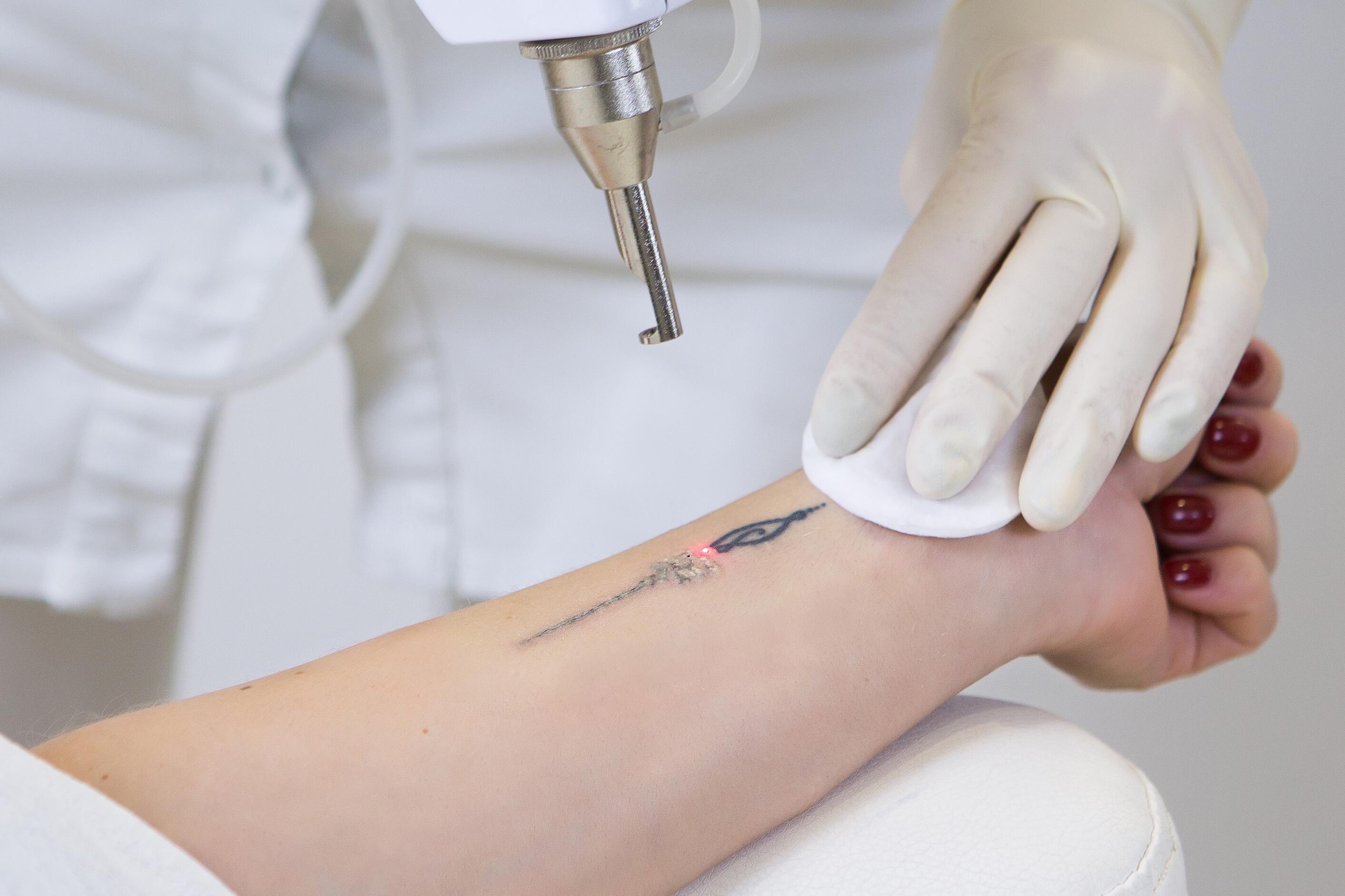détatouage cicatrice avant bras